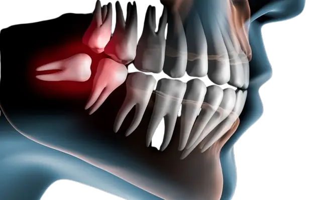 wisdom tooth removal in valasaravakkam